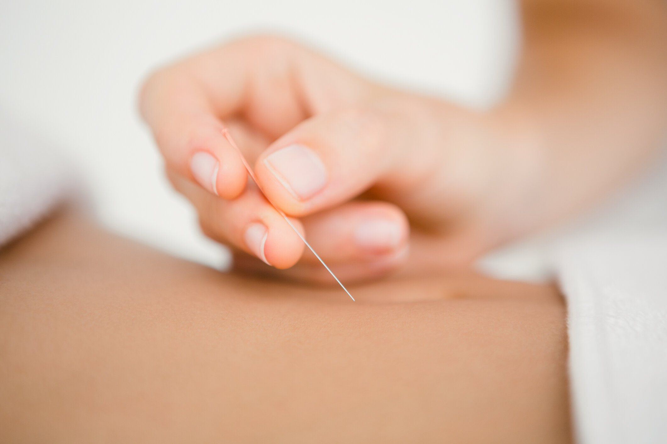 Acupuncture treatment by Laura Jones